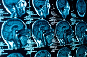 Neurorradiología Intervencionista